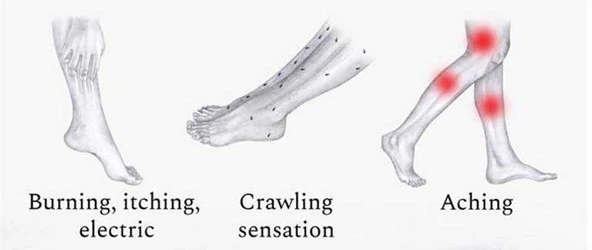 Restless legs syndrome RLS Restless legs syndrome RLS